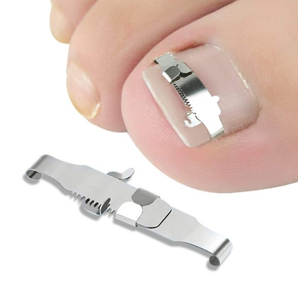 Ingrown Toenail Straightening Clip Stainless Steel Toenail Correction Clip Toe - Picture 8 of 8
